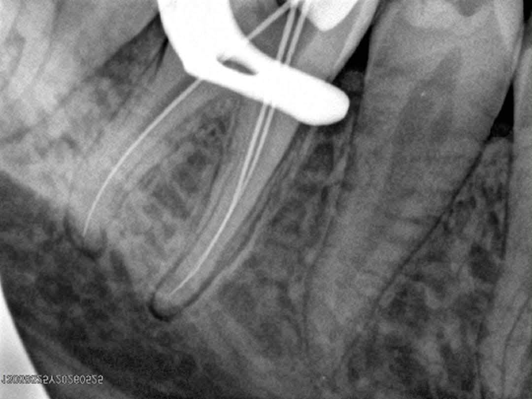 Dental clinic documents a root canal case with Dr Mazen Obid — photo 2