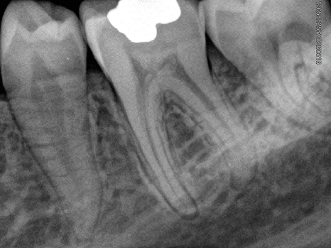 Dental clinic documents a root canal case with Dr Mazen Obid — photo 3