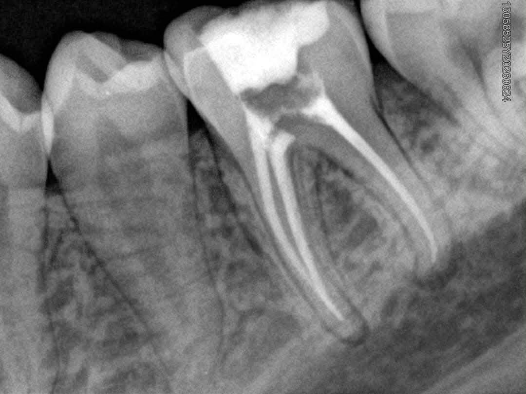 Dental clinic documents a root canal case with Dr Mazen Obid
